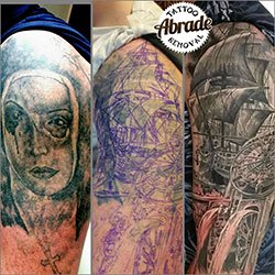 Tattoo Removal Belfast | abrade tattoo removal derry Tattoo Removal Belfast | abrade tattoo removal derry