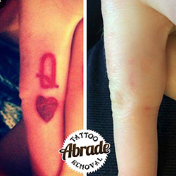 abrade tattoo removal derry abrade tattoo removal derry